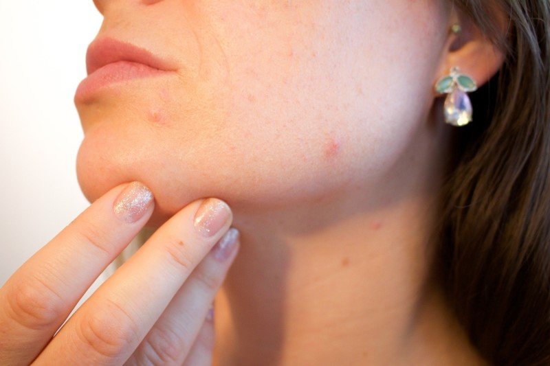 Acne scars laser treatment